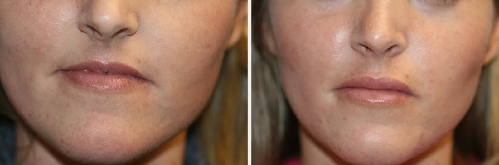 Before and after permanent lip augmentation with a custom ultrasoft silicone lip implant