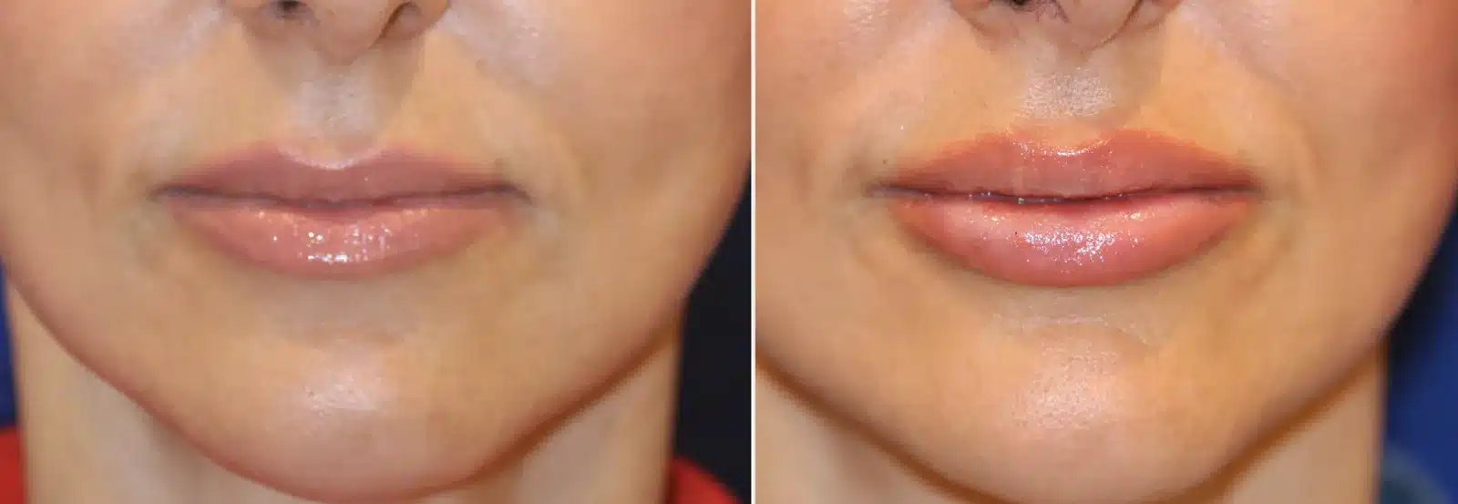 Before-and-after, frontal view, of a patient after a silicone lip implant with Bellafill border injection