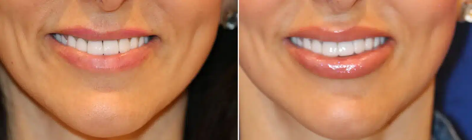 Before-and-after, smiling view, of a patient after a silicone lip implant with Bellafill border injection