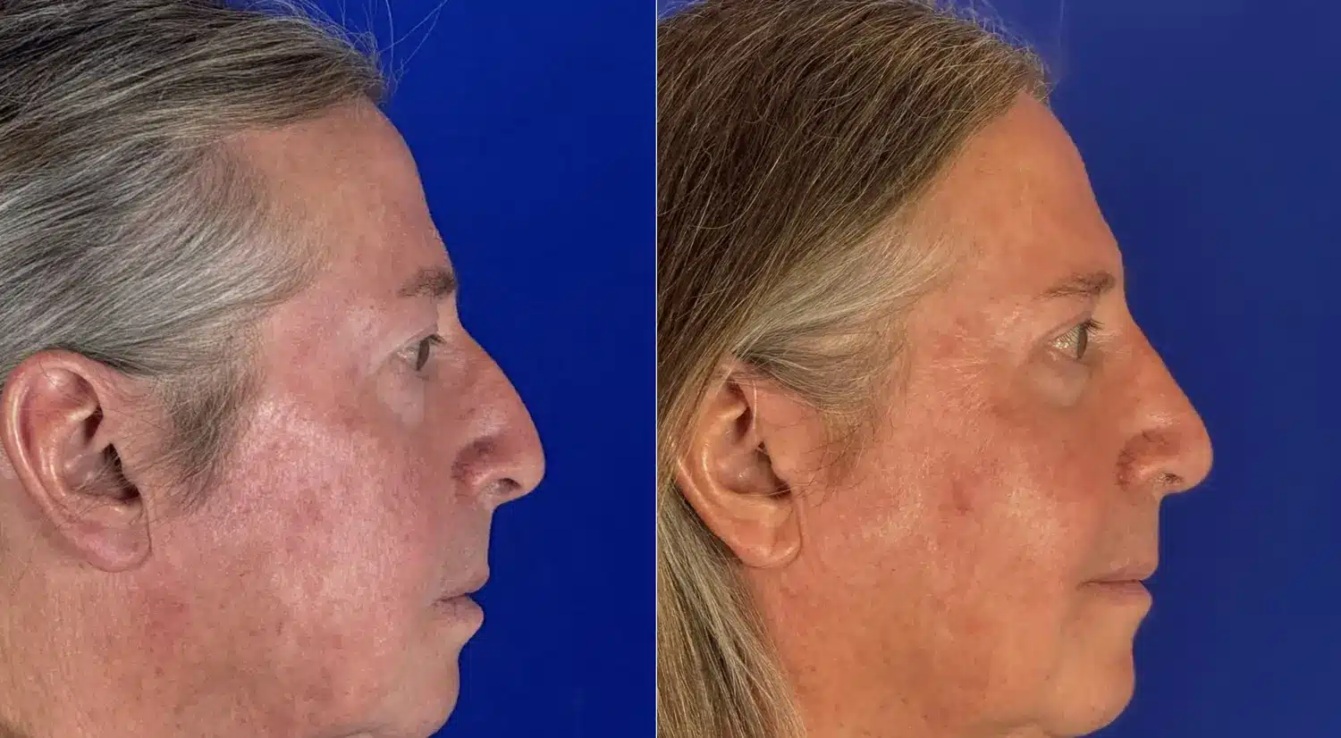 Rhinoplasty before and after, left profile &mdash; refined nasal bridge and dorsal profile