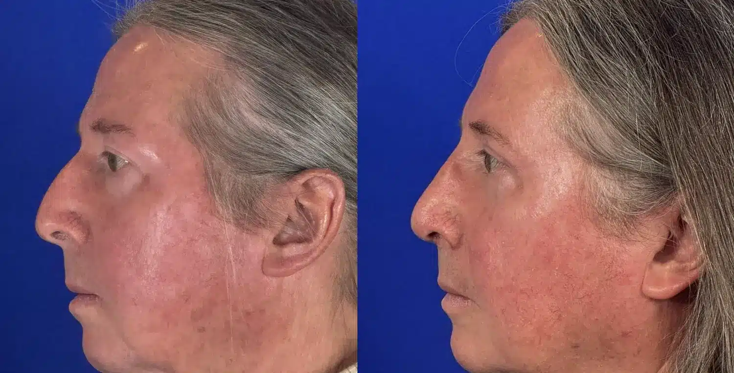 Rhinoplasty before and after, right profile &mdash; refined nasal bridge and dorsal profile