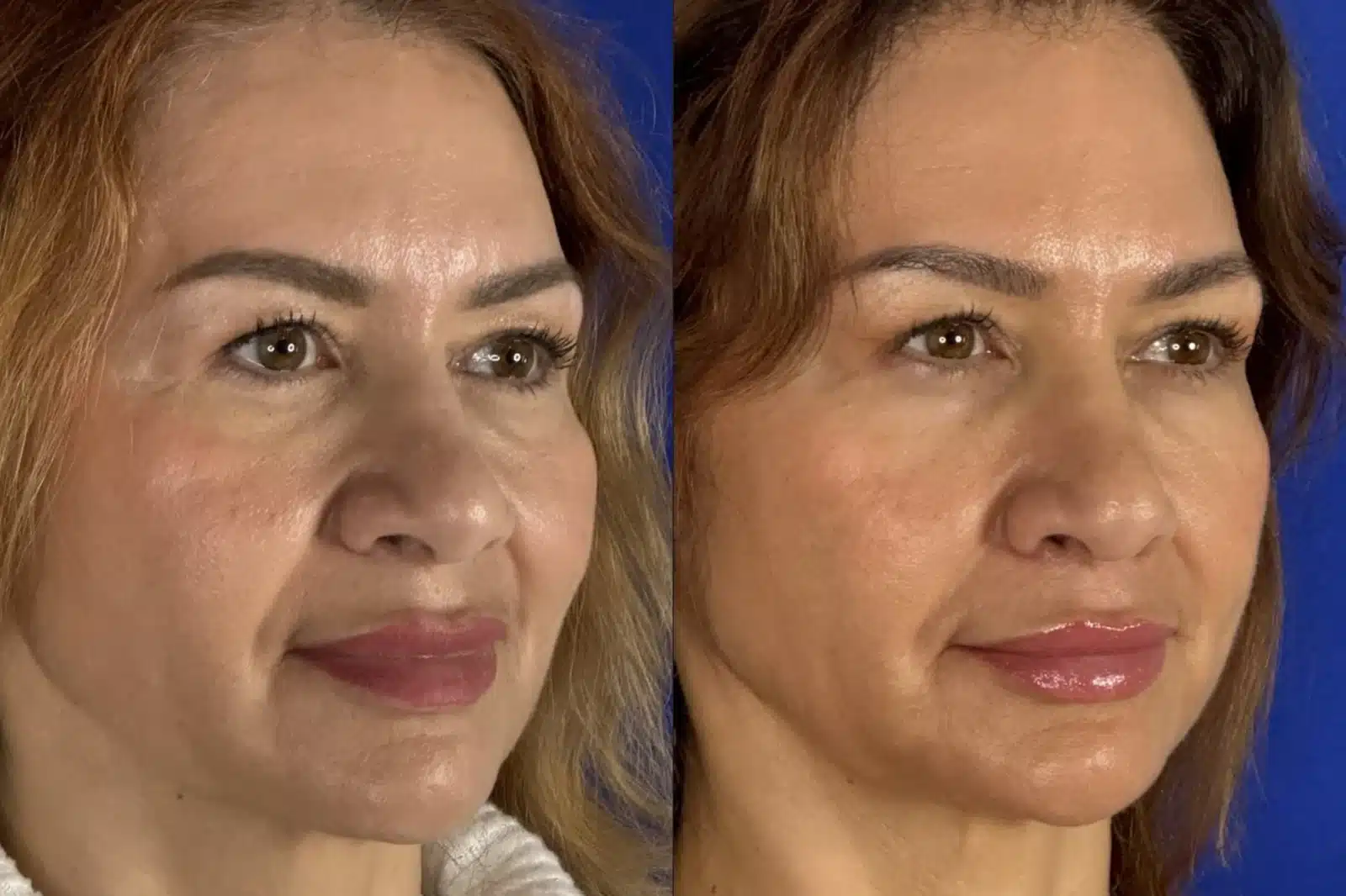 Rhinoplasty before & after, front view &mdash; Patient 9 &mdash; Cosmetic Rhinoplasty
