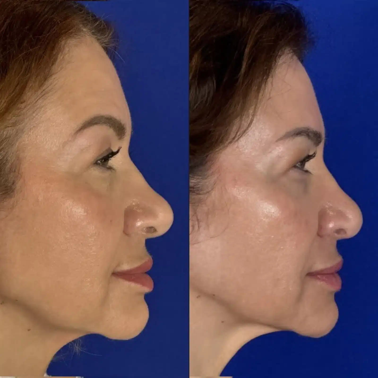 Rhinoplasty before & after, left profile &mdash; Patient 9 &mdash; Cosmetic Rhinoplasty