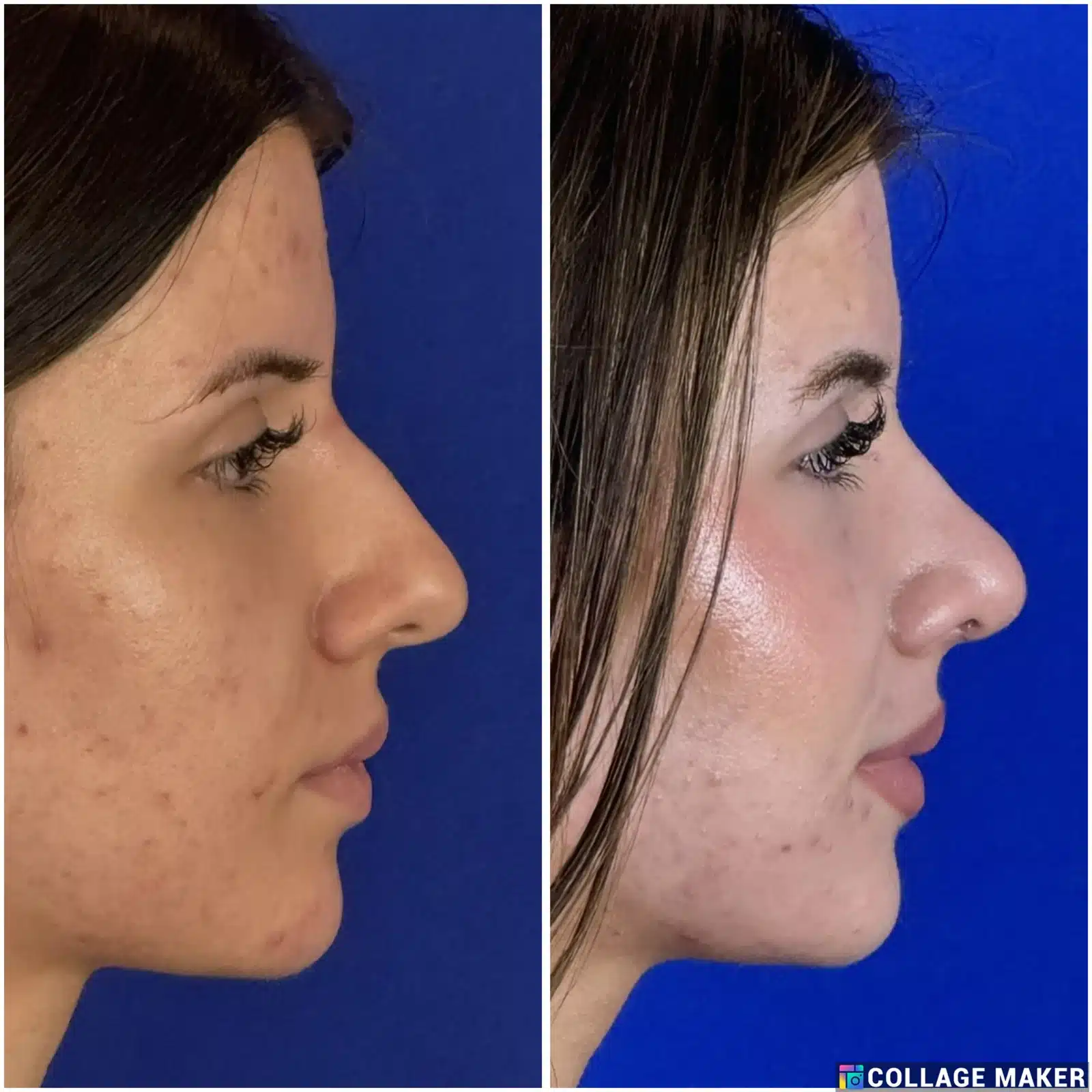 Rhinoplasty before & after, left profile &mdash; Patient 10 &mdash; Profile Rhinoplasty