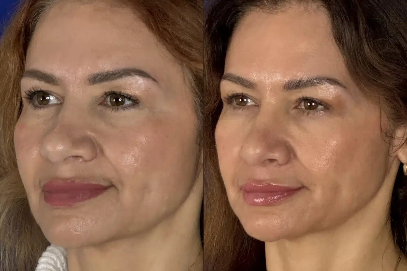 Rhinoplasty before & after, three-quarter view &mdash; Patient 9 &mdash; Cosmetic Rhinoplasty