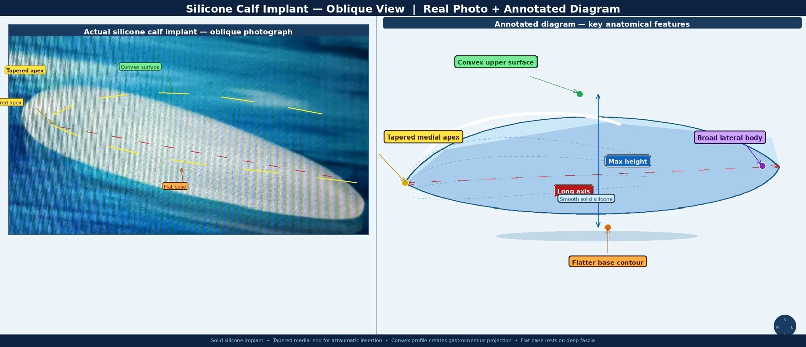 Annotated diagram of a custom ultrasoft silicone lip implant shape and features