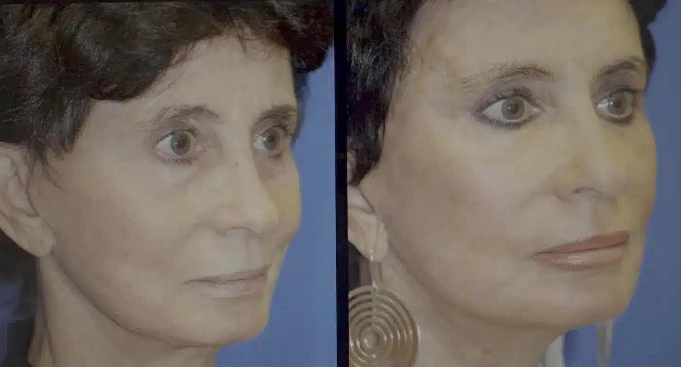 Before and after of facial fat grafting to the temples and face combined with CO2 laser skin resurfacing, showing restored temple fullness