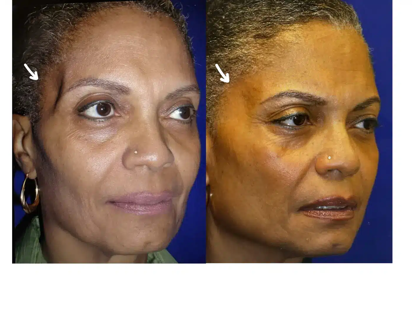 Before and after oblique view of facial fat grafting restoring temple and midface volume