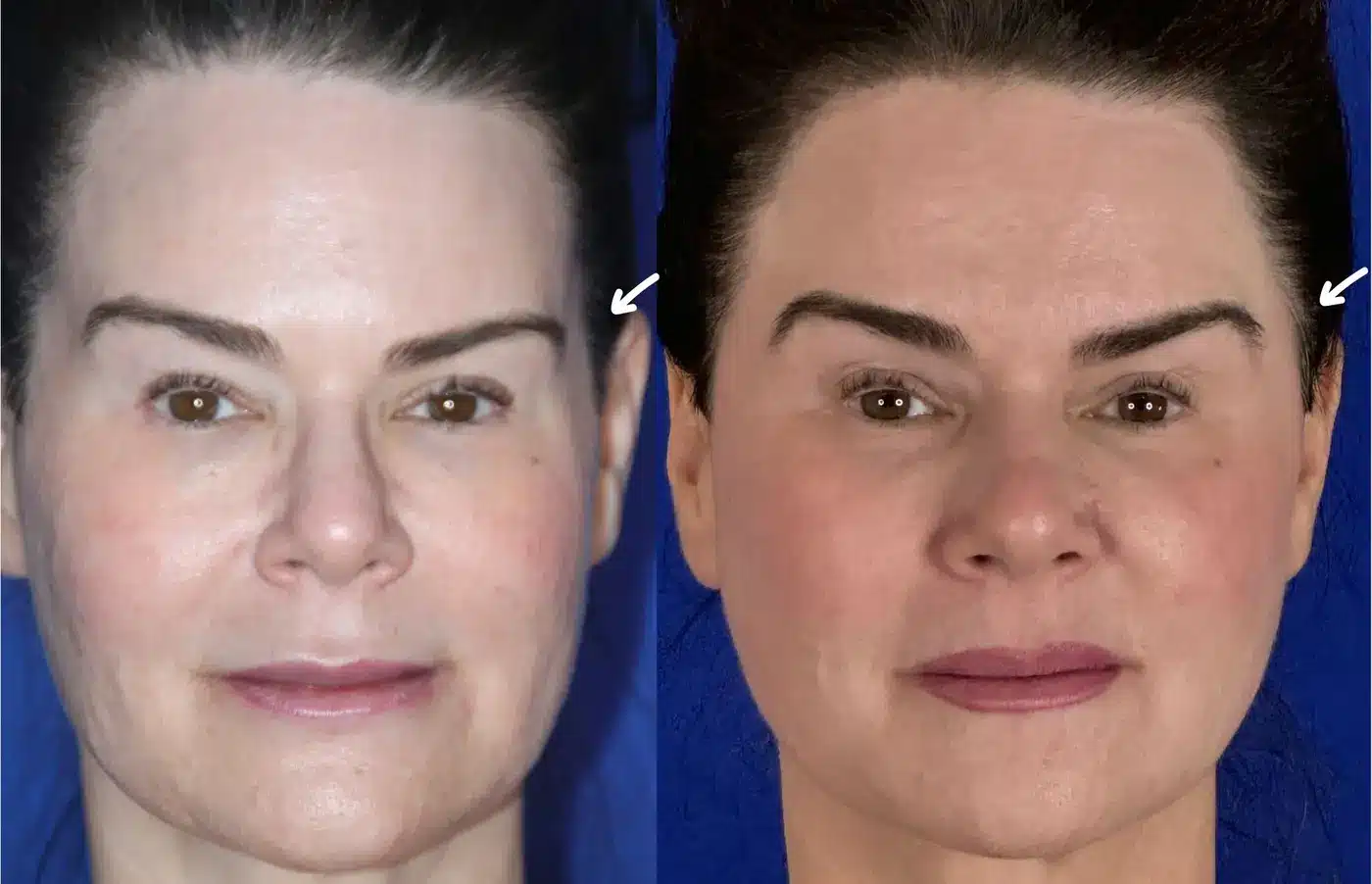 Before and after frontal view of temple implant placement showing a fuller, smoother temple contour