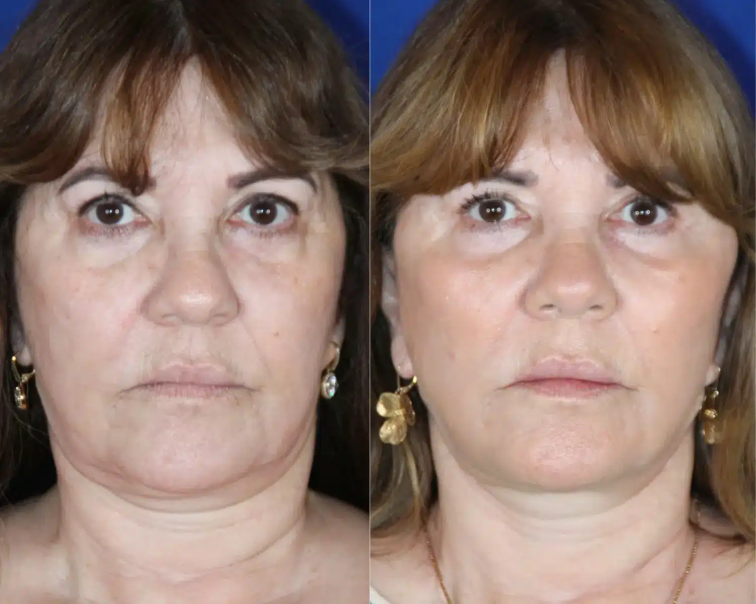 Before and after of temporal implant placement restoring temple and midface volume, front view