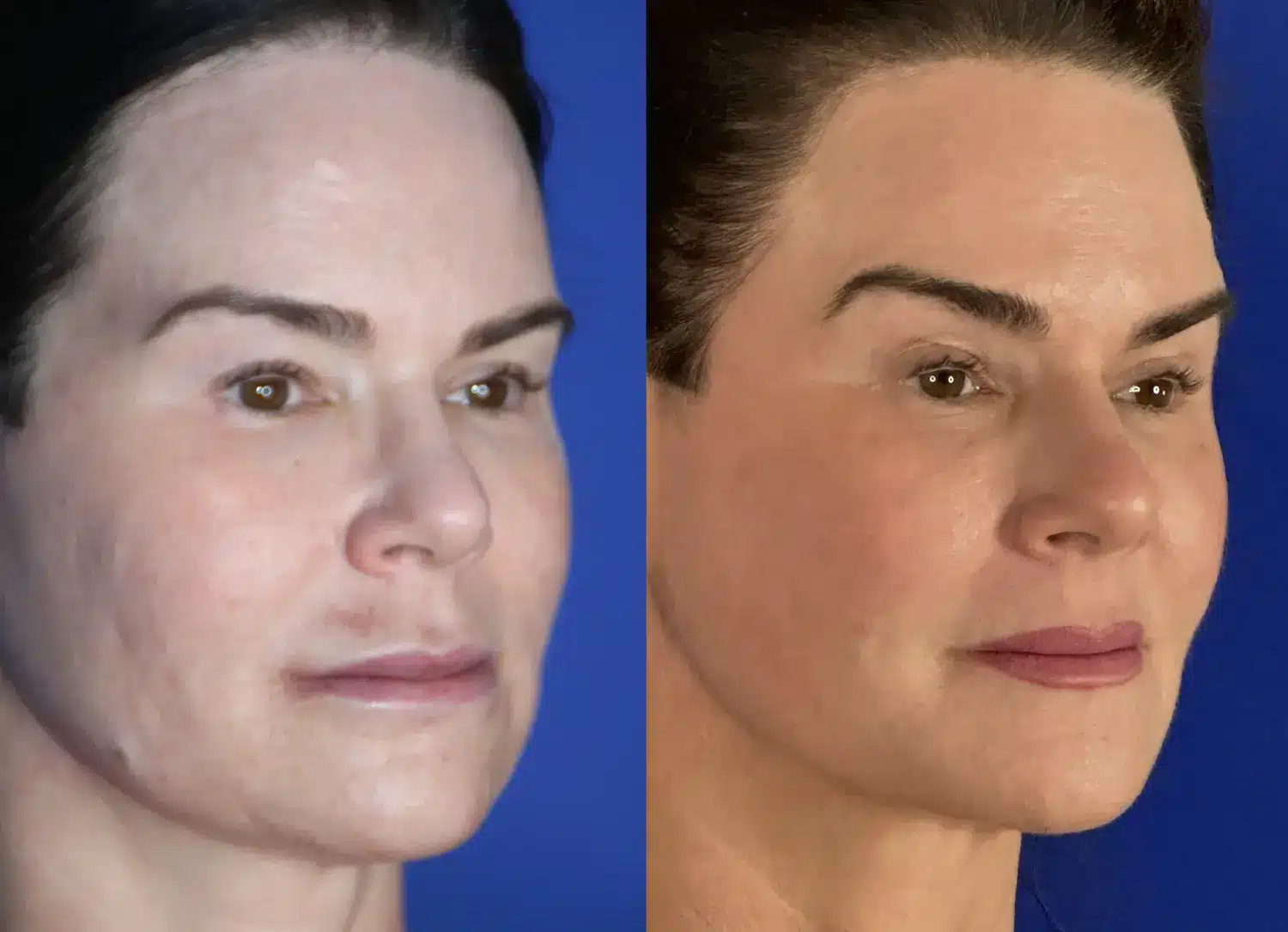 Before and after of temporal implant placement restoring temple and midface volume, oblique view