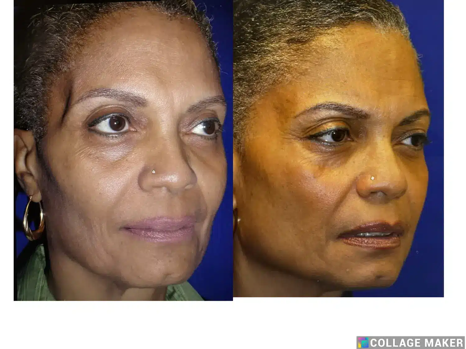 Before and after of temporal implant placement restoring temple and midface volume, oblique view