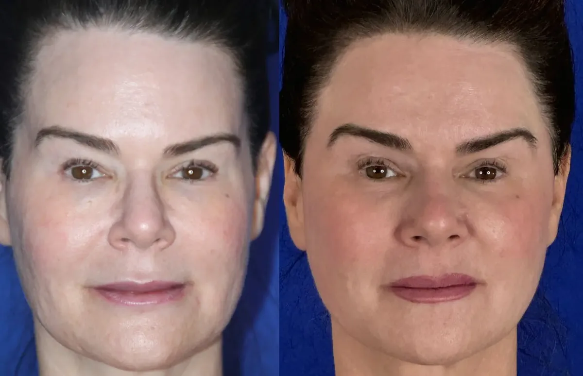 Before and after a temporal implant by Dr. Robert J. Troell &mdash; a woman whose hollow, concave temples beside the brow are rebuilt into a smooth, fuller upper-face contour