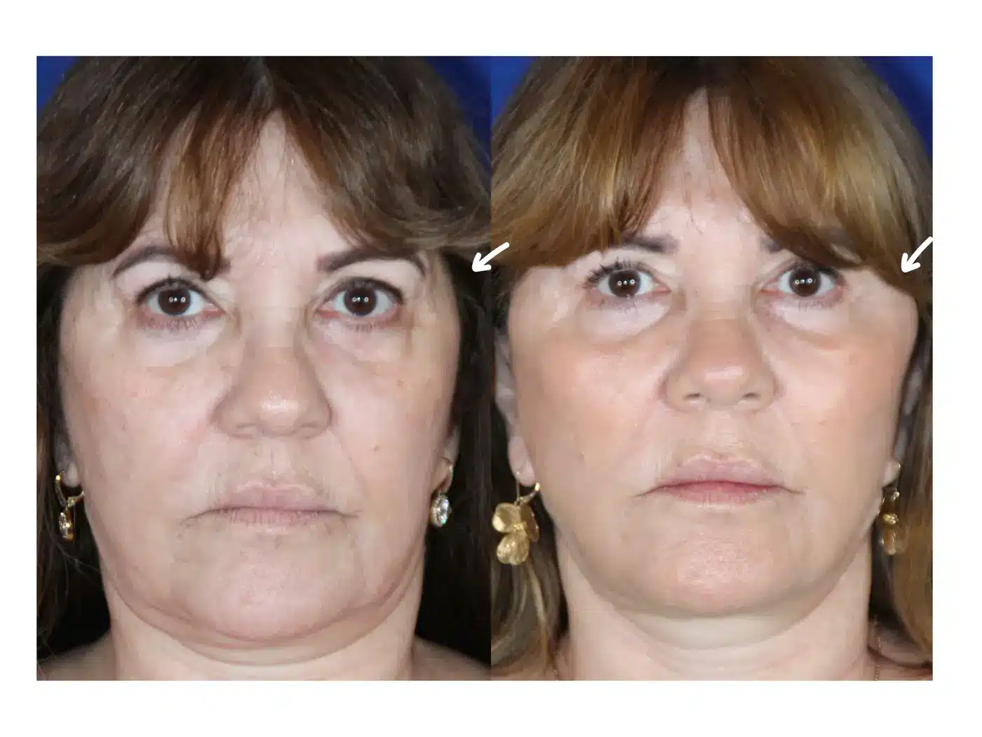 Before and after of combined temporal and midface silastic implant placement, showing improved volume of the temple and middle face