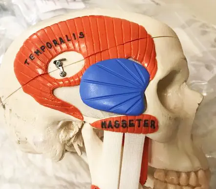 Skull model showing the temporalis muscle and the position where a temple implant is placed beneath the muscle covering