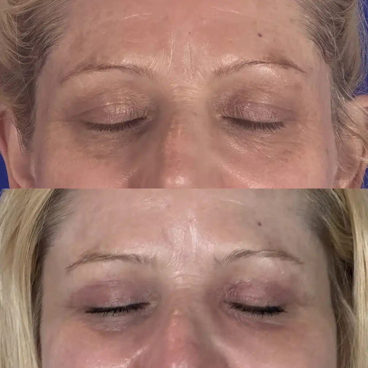Upper blepharoplasty before & after, eyes closed &mdash; Patient 15 &mdash; Upper Blepharoplasty