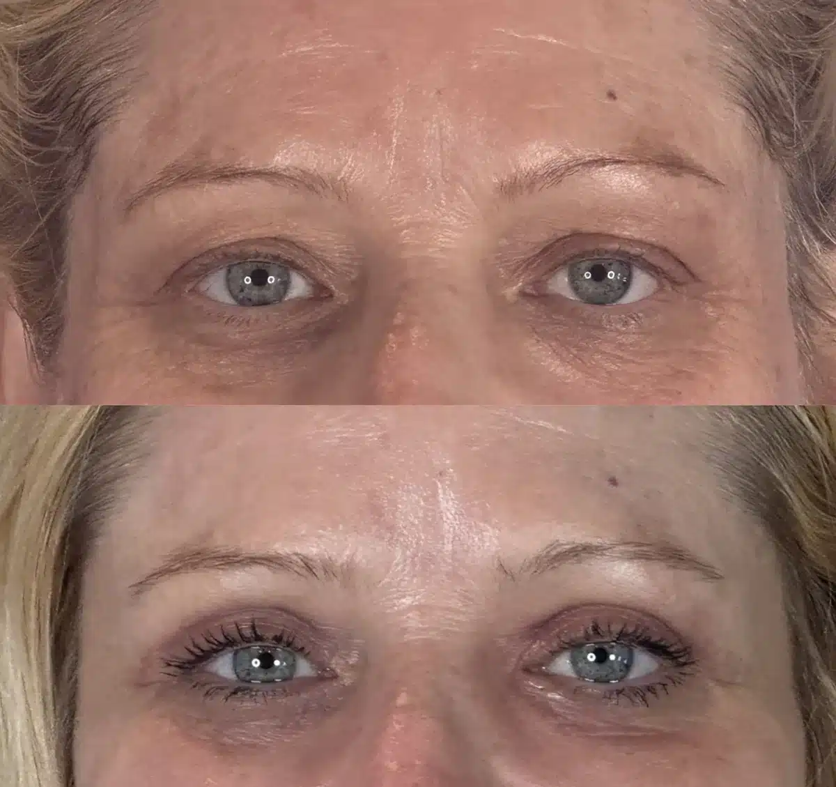 Upper blepharoplasty before & after, eyes open &mdash; Patient 15 &mdash; Upper Blepharoplasty