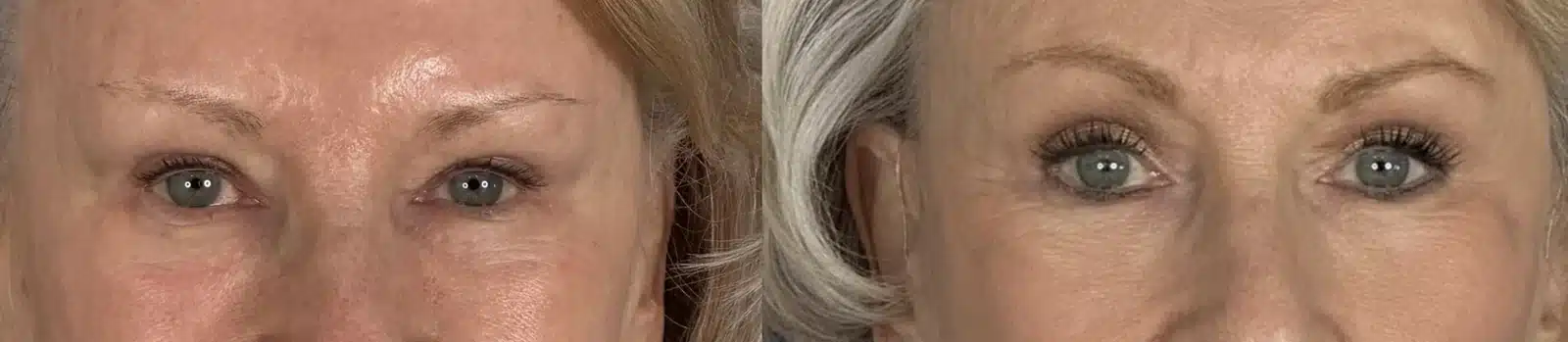 Upper blepharoplasty before & after, front view &mdash; Patient 14 &mdash; Upper Blepharoplasty