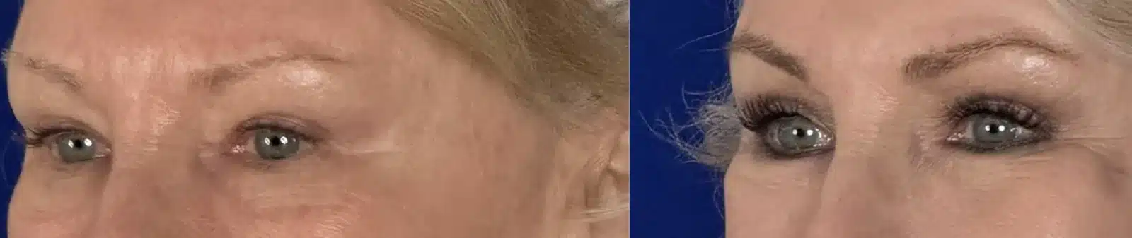 Upper blepharoplasty before & after, oblique view &mdash; Patient 14 &mdash; Upper Blepharoplasty