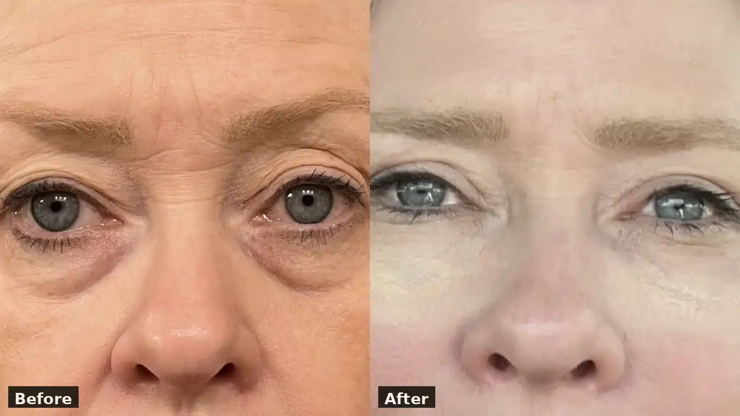 Upper blepharoplasty and periorbital rejuvenation before and after, front view &mdash; Dr. Troell, Las Vegas