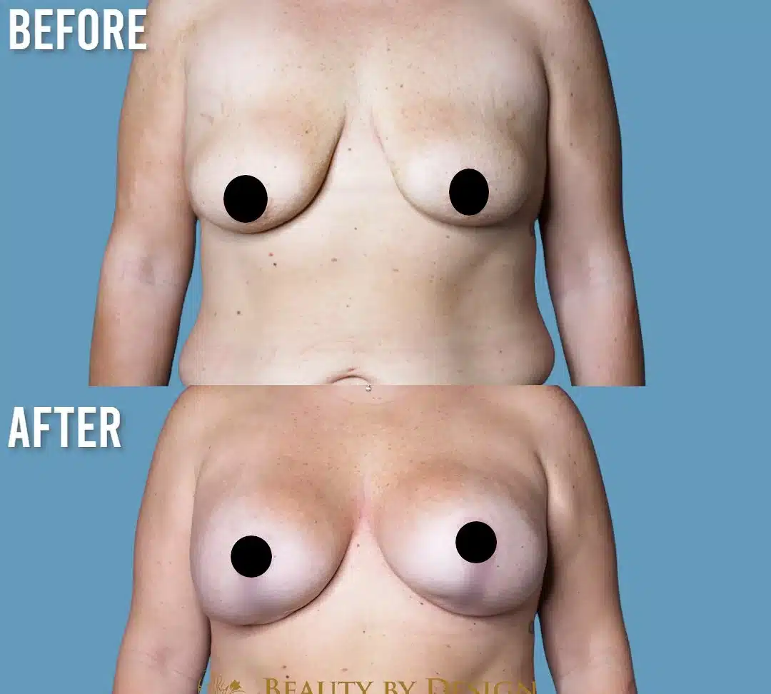 Before and after revision breast surgery for capsular contracture, identity protected