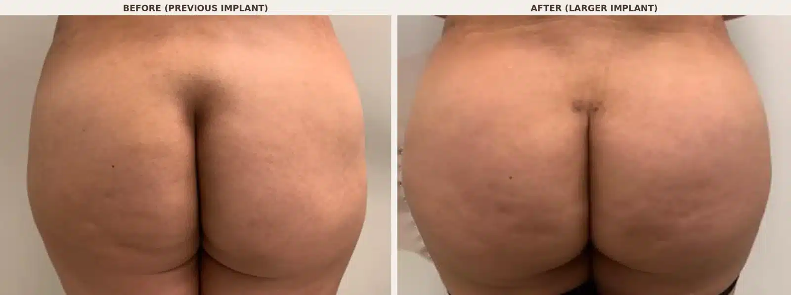 Revision buttock implant case, before with previous implant and after with larger 460cc implant