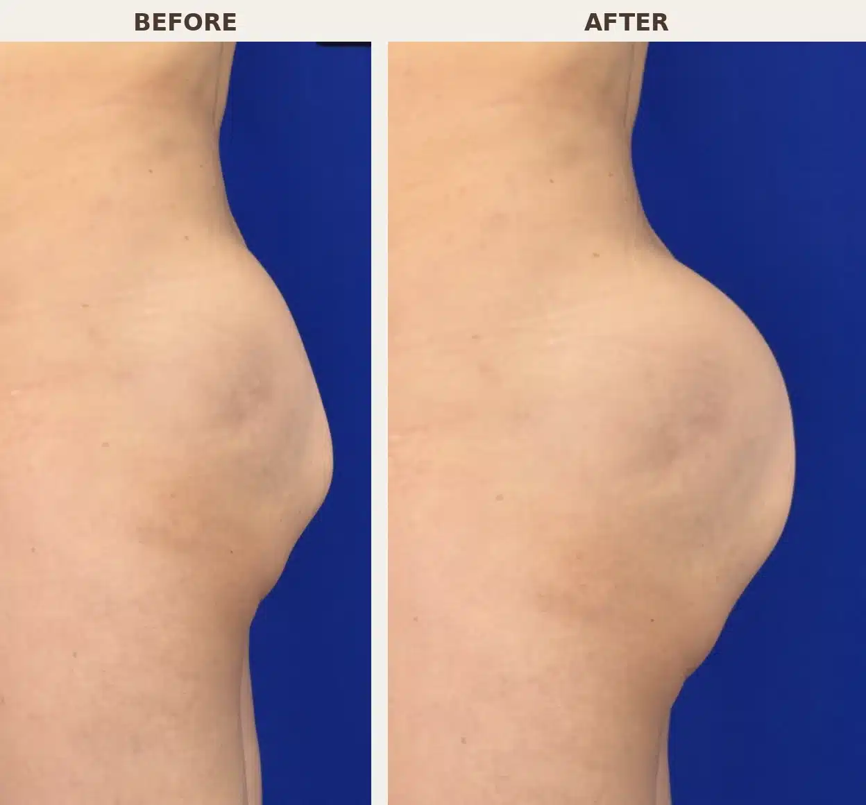 Before and after lateral view of buttock implant augmentation showing added projection