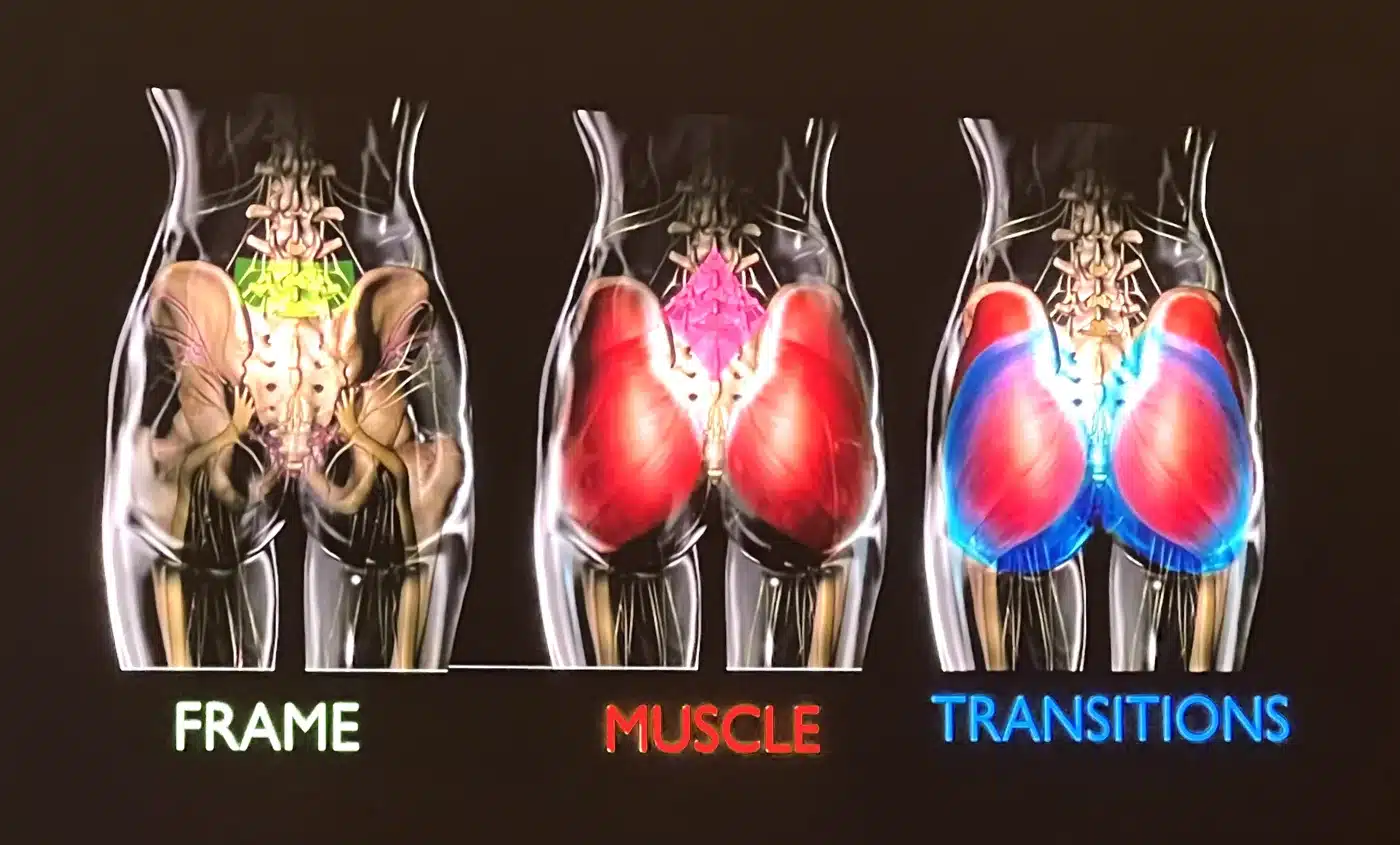 Three-panel 3D analysis of the bony frame, gluteal muscle, and fat transition zones that determine buttock shape