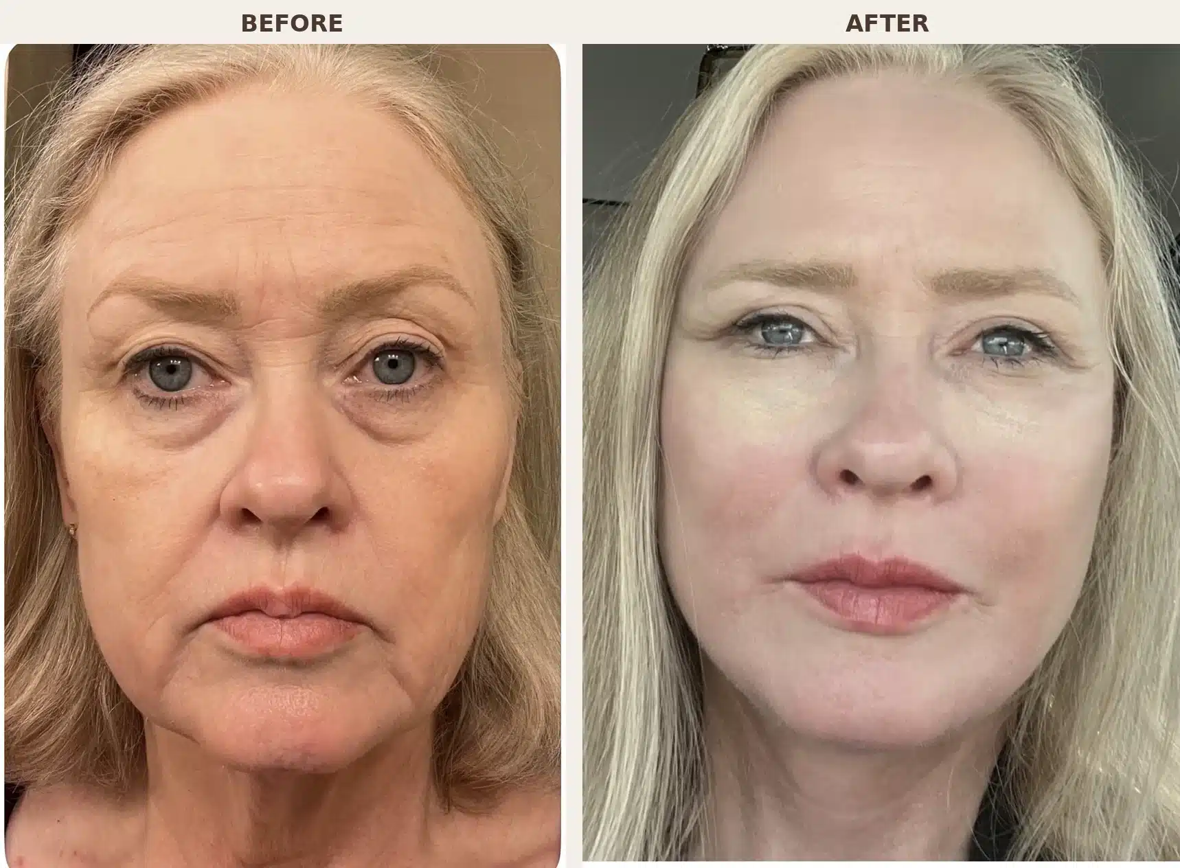 Before and after front view of a 65-year-old patient after deep plane facelift and comprehensive facial rejuvenation by Dr. Troell