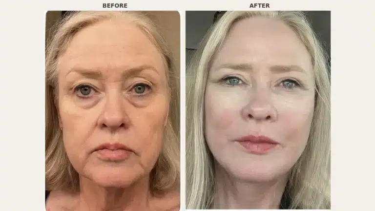 Deep Plane Facelift After Ozempic Weight Loss: A Real Patient Case Study