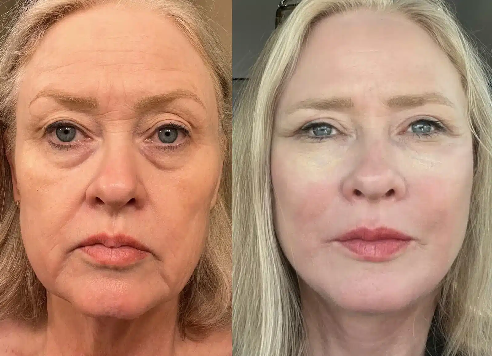 Facelift front view &mdash; Patient 3 &mdash; Facelift Results