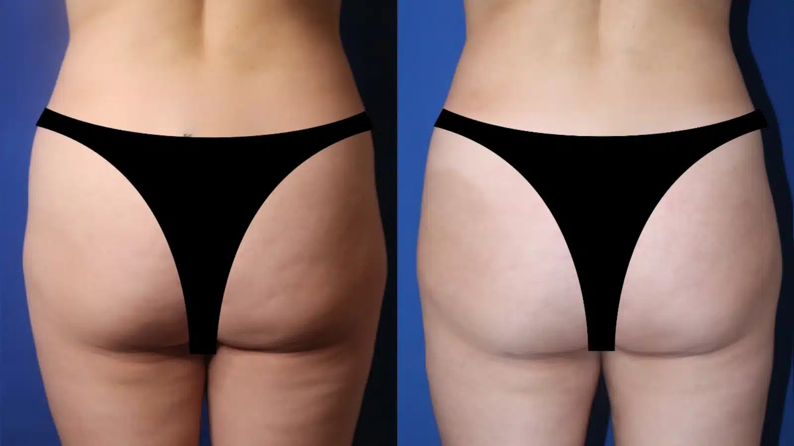 Fat grafting to hips and buttocks before and after &mdash; Patient 6, rear three-quarter view