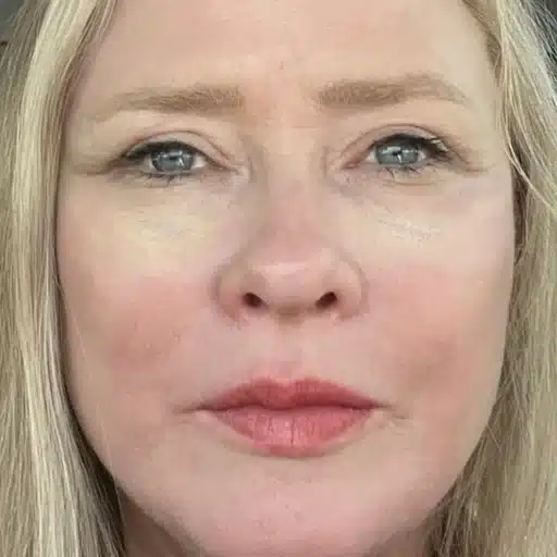 Facelift results