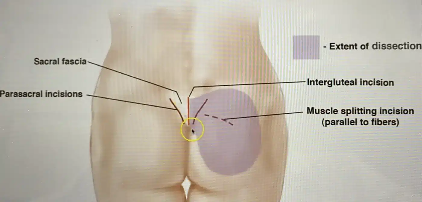Labeled illustration of parasacral incisions, intergluteal incision, muscle-splitting incision, and extent of dissection