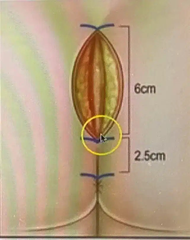 Illustration of intergluteal incision length planning for gluteal implant placement