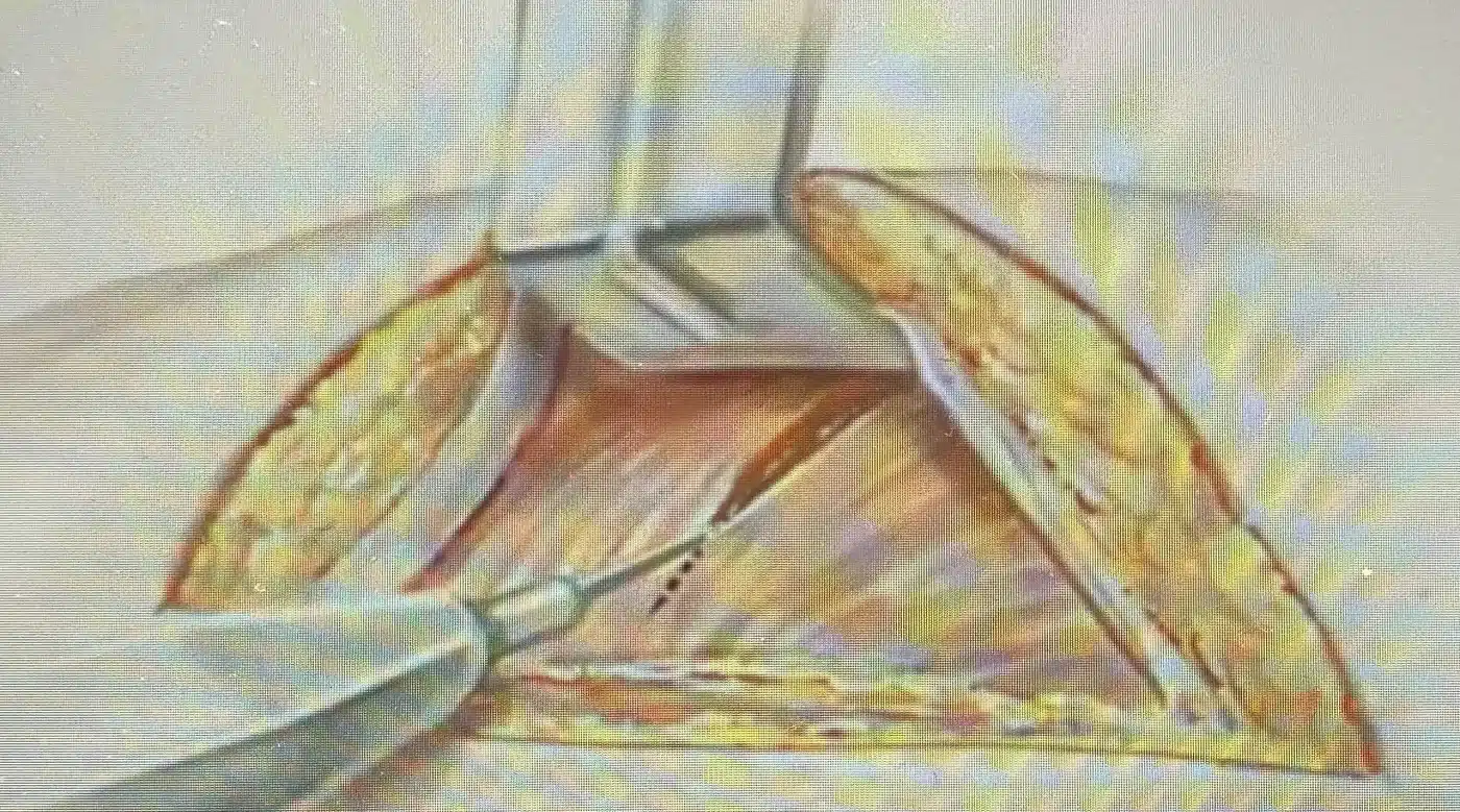 Illustration of blunt intramuscular pocket creation preserving a thick muscle layer over the implant