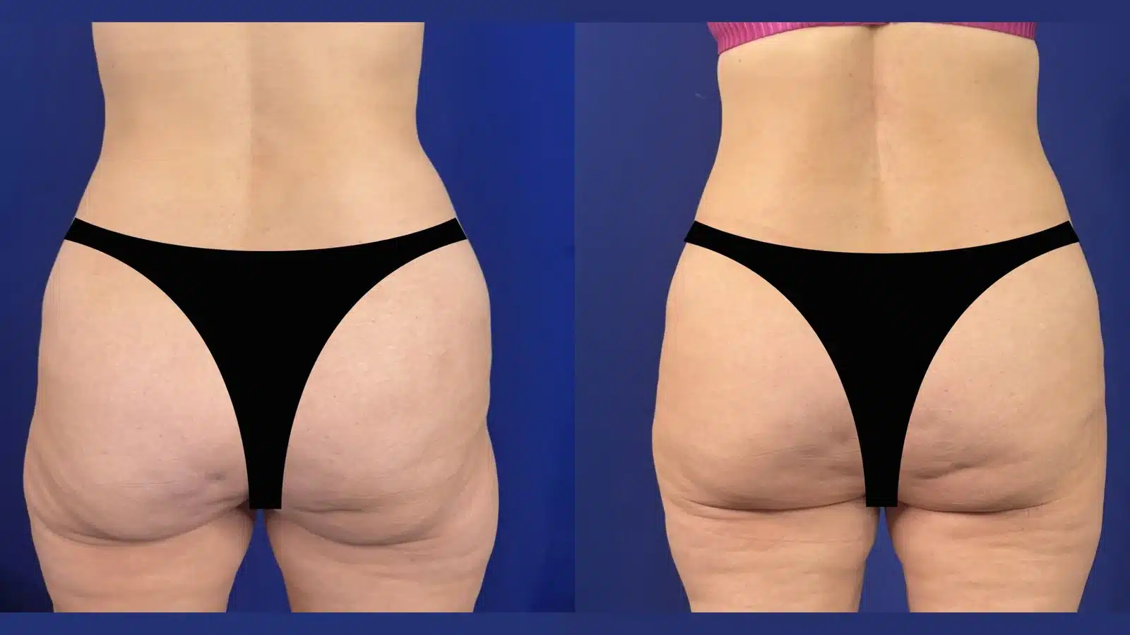 Fat transfer to hip dips before and after &mdash; rear view showing smoothed hip contour