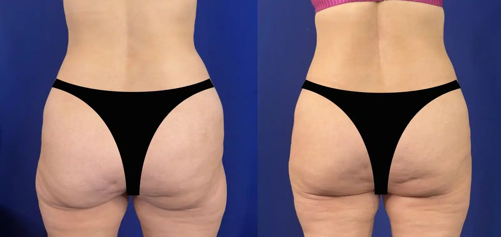 Fat grafting to hips/glutes before and after &mdash; Patient 5, rear view