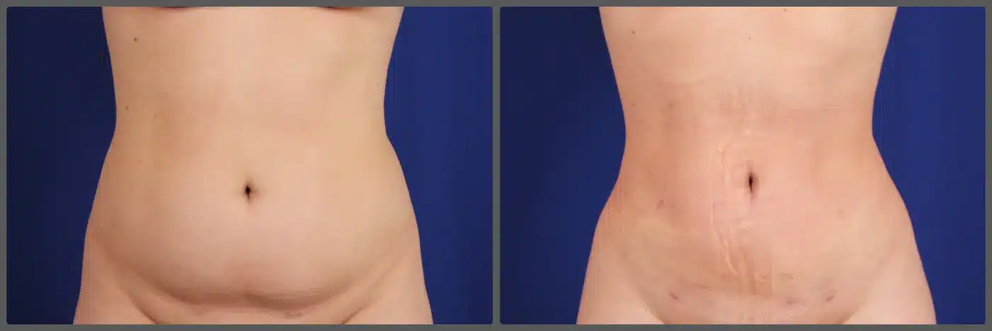 Before and after liposuction 360 of the abdomen &mdash; patient of Dr. Troell, Las Vegas