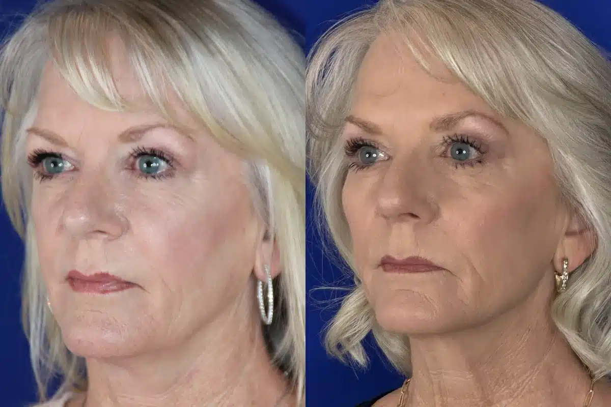 Before and after midface silastic implant placement by Dr. Robert J. Troell &mdash; a woman whose flattened midface and deepened nasolabial folds are restored to a fuller, smoother cheek contour