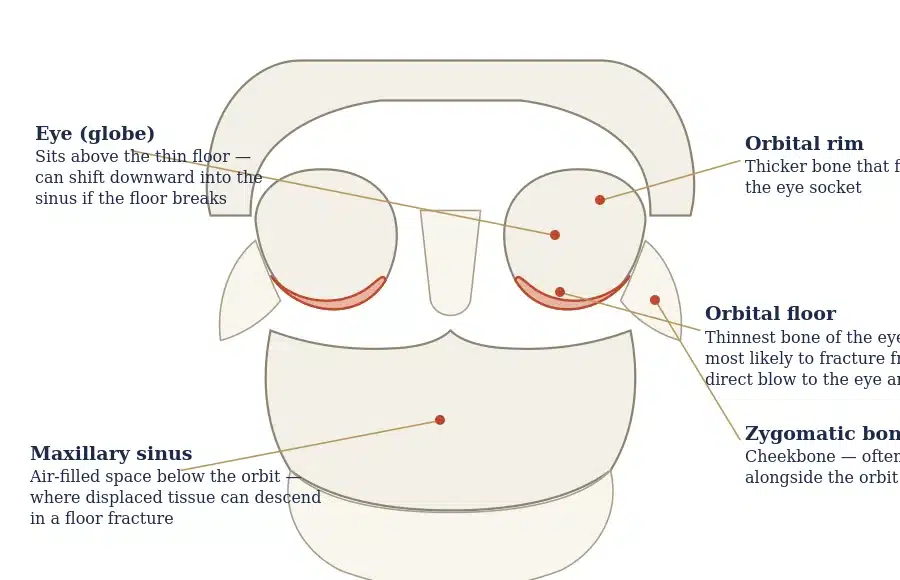 Anatomical diagram of the eye socket showing the orbital rim, thin orbital floor, maxillary sinus, and zygomatic bone