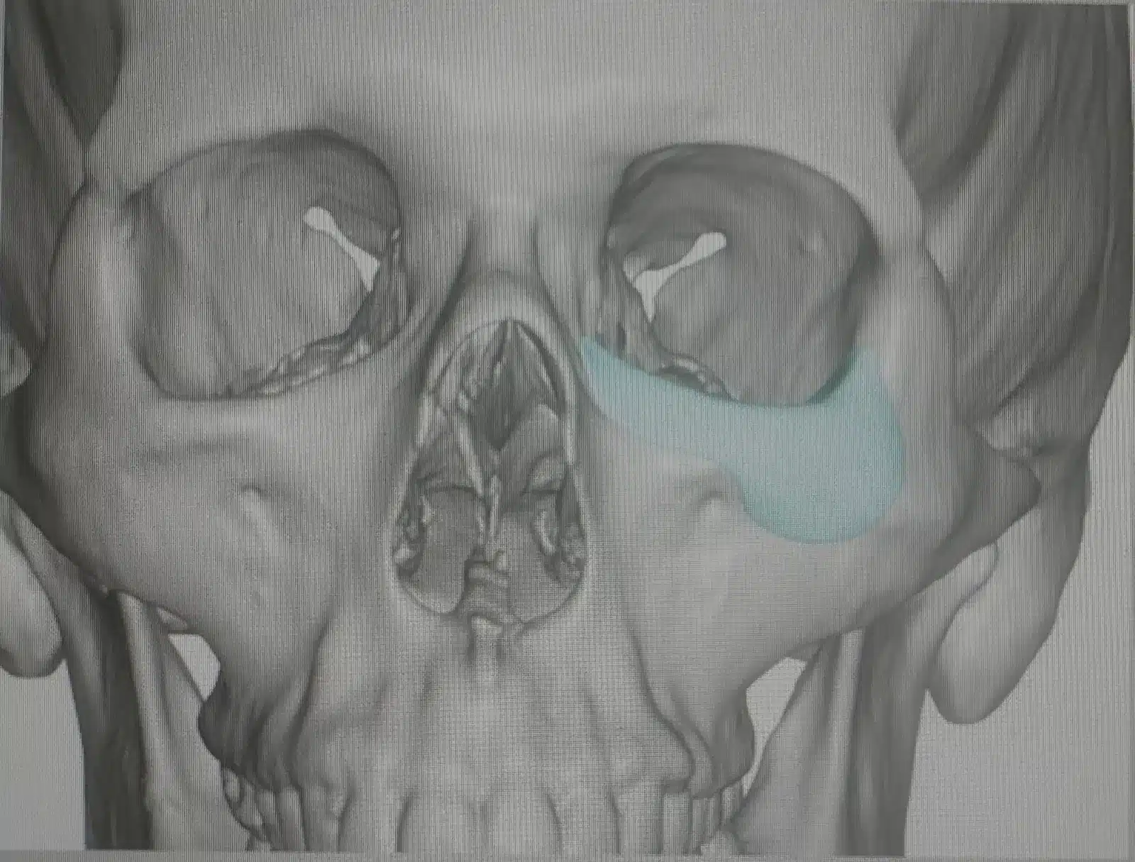 3D facial CT reconstruction with an orbital floor and rim implant overlay showing where a fracture repair is placed