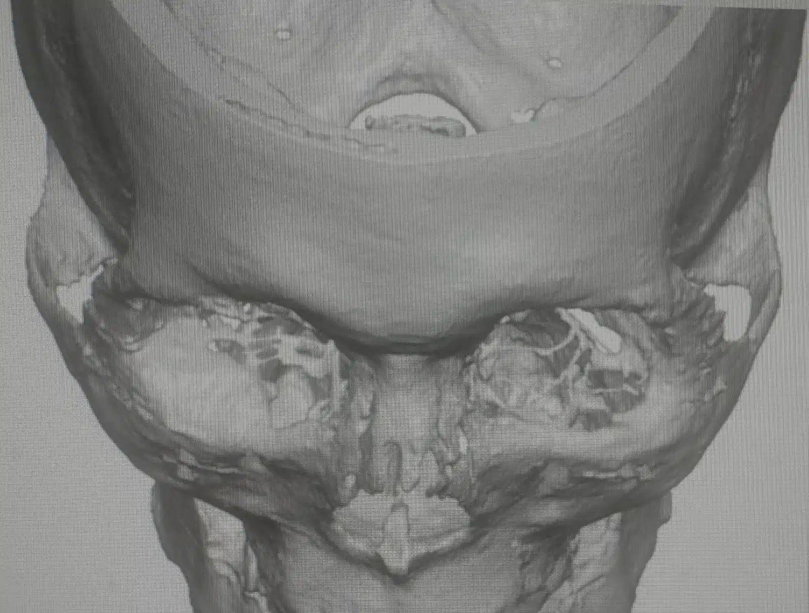 3D facial CT scan reconstruction showing the thin orbital floor beneath the eye socket