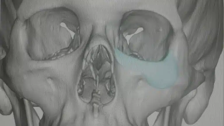 What Ilia Topuria’s Orbital Fractures Teach Us About Eye-Socket Injuries