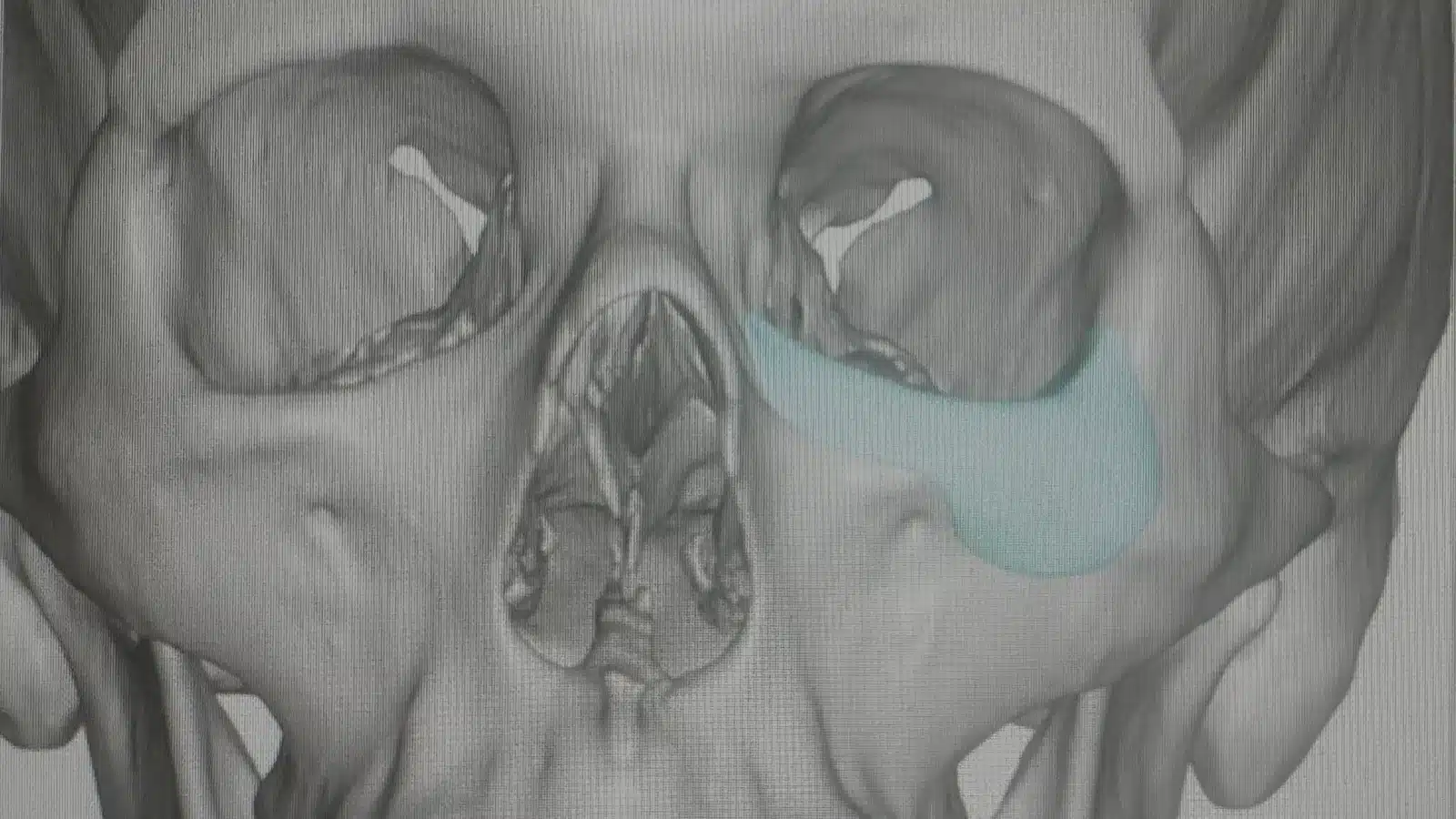 What Ilia Topuria&rsquo;s Orbital Fractures Teach Us About Eye-Socket Injuries