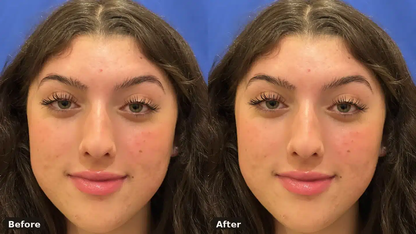 Rhinoplasty before and after, front view &mdash; Dr. Troell, Las Vegas