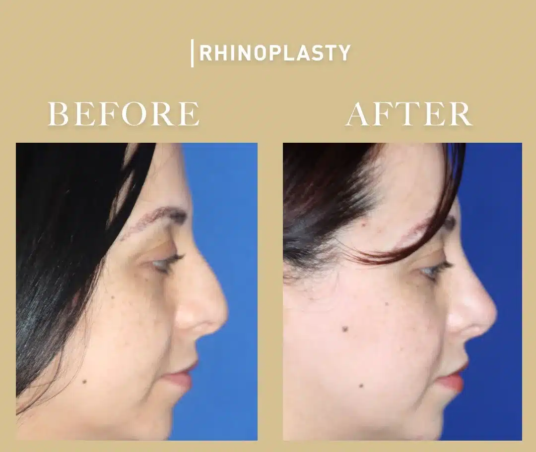 Rhinoplasty before and after &mdash; real patient result
