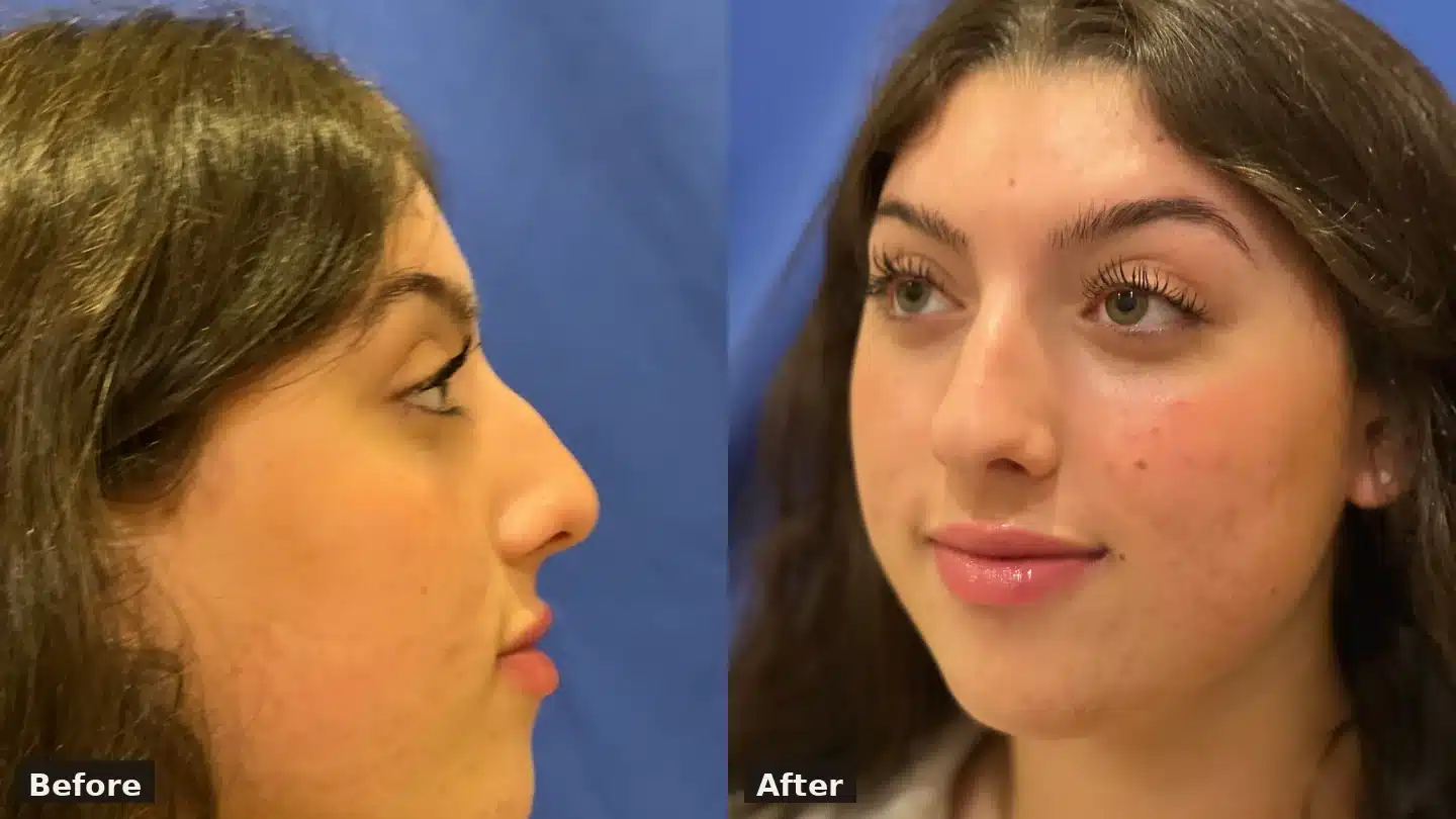 Rhinoplasty before and after, side view (dorsal hump reduction and tip refinement) &mdash; Dr. Troell, Las Vegas