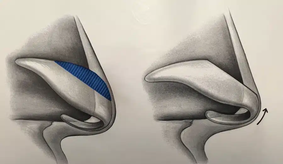 Rhinoplasty technique diagram &mdash; dorsal hump reduction (nasal bridge cartilage and bone)