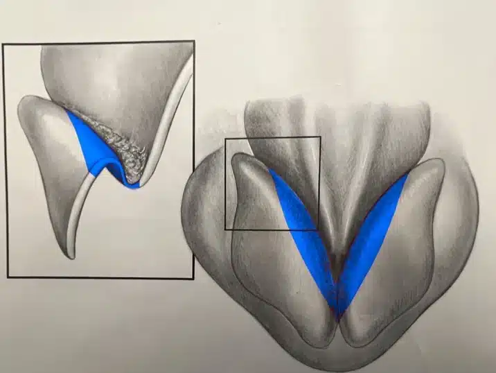 Rhinoplasty technique diagram &mdash; nasal tip cartilage refinement (cephalic strip removal)